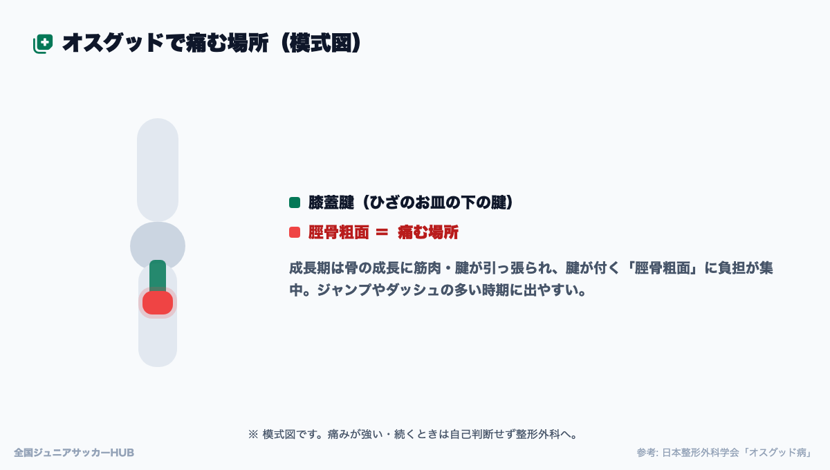 オスグッドで痛む場所の模式図（脛骨粗面）